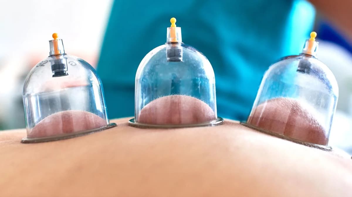 Doctor-Led Dry Needling in Dubai at Physio Cure Dubai